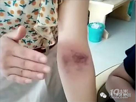 手臂内侧打紫了是湿气 医生 那是毛细血管被打破了 城事 杭州19楼手机版