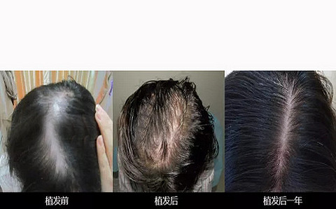 植发到沈阳碧莲盛有哪些因素会影响费用