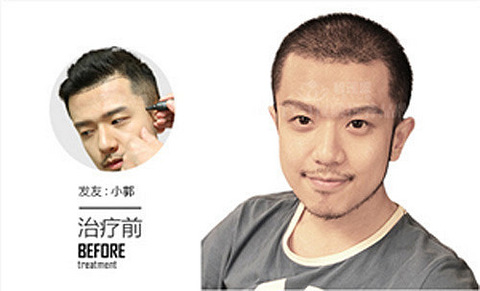 有没有移植鬓角到西安碧莲盛植发后效果的对比