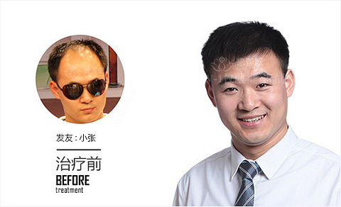 昆明碧莲盛植发能不能治遗传性脱发