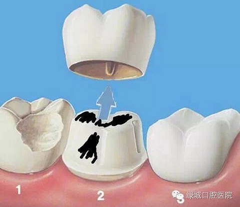 当烤瓷牙出现这些问题快快去拆除