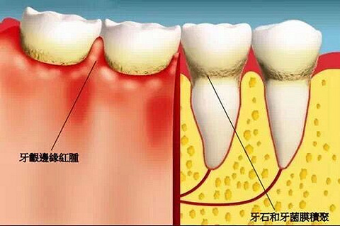 洗牙有没有必要,看完后你就能解开多年来的疑