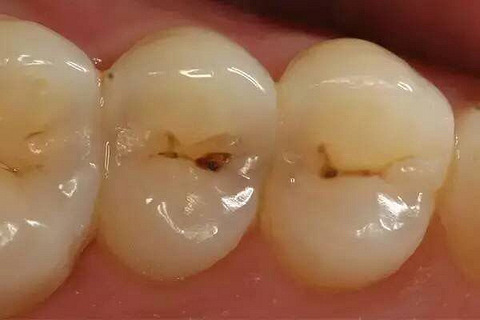 蛀牙这件小事,为什么会成为很多人的噩梦?