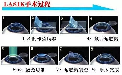 武汉准分子、半飞秒、全飞秒、ICL近视手术价
