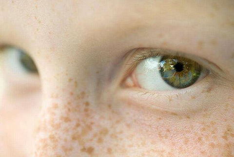 脸上长了黄褐斑怎么根治