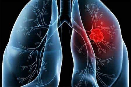 早期肺癌治愈率高,如何护理好?