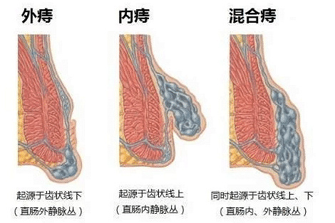治疗痔疮用什么药最好?这个有效疗方你不要错