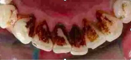 我明明每天早晚都刷牙,为什么医生还让我洗牙