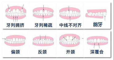 杭州牙齿矫正年龄限制是什么时候?