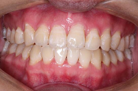 选择厦门登特口腔做牙齿矫正一半为健康一半为