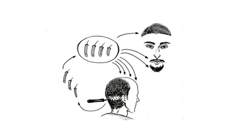 植发效果是永久性的吗,对身体会不会有危害?