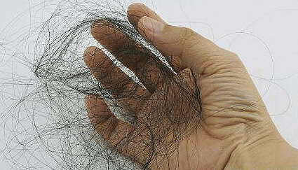 如何养护头皮头发?北京毛囊移植多少钱?科发