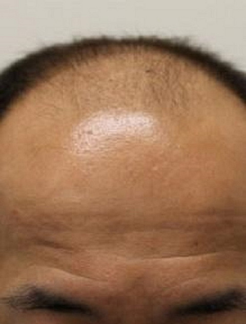 植发后出现毛囊炎怎么办?怎么能有效处理它呢