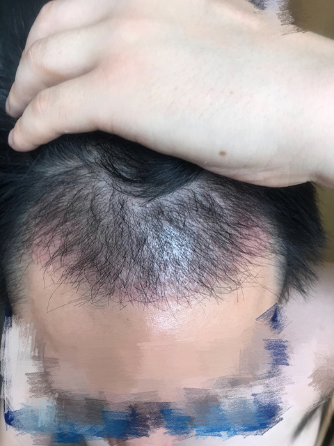 杭州科发源植发,亲身体验,给犹豫植发的朋友一