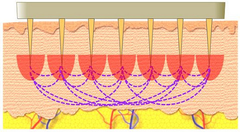西安画美医疗美容医院-生完孩子妊娠纹可以自