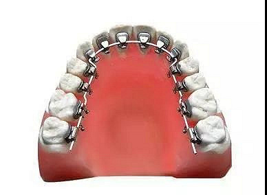 西安画美医疗美容医院-舌侧矫正会反弹吗