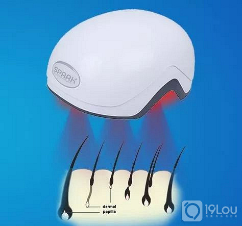 植头发靠谱吗?90后脱发没钱植发,除了植发就没