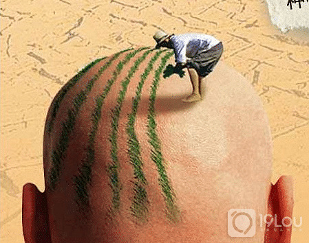 秃顶了都可以植发吗,长沙秃顶植发效果