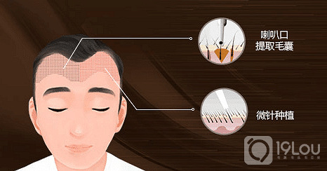 宁波新生植发微针植发技术升级,微针植发为什