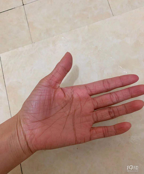 鱼鳞病不可怕吗 我一伸出手 大家都吓到了 健康之家 杭州19楼手机版 鱼鳞病不可怕吗 我一伸出手 大家都吓到了 健康之家 杭州19楼手机版