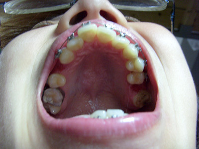 牙齿矫正了一年半结果门牙还是歪的,怎么办啊