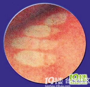 香港出现猩红热细菌变性 已有两孩子染病死亡