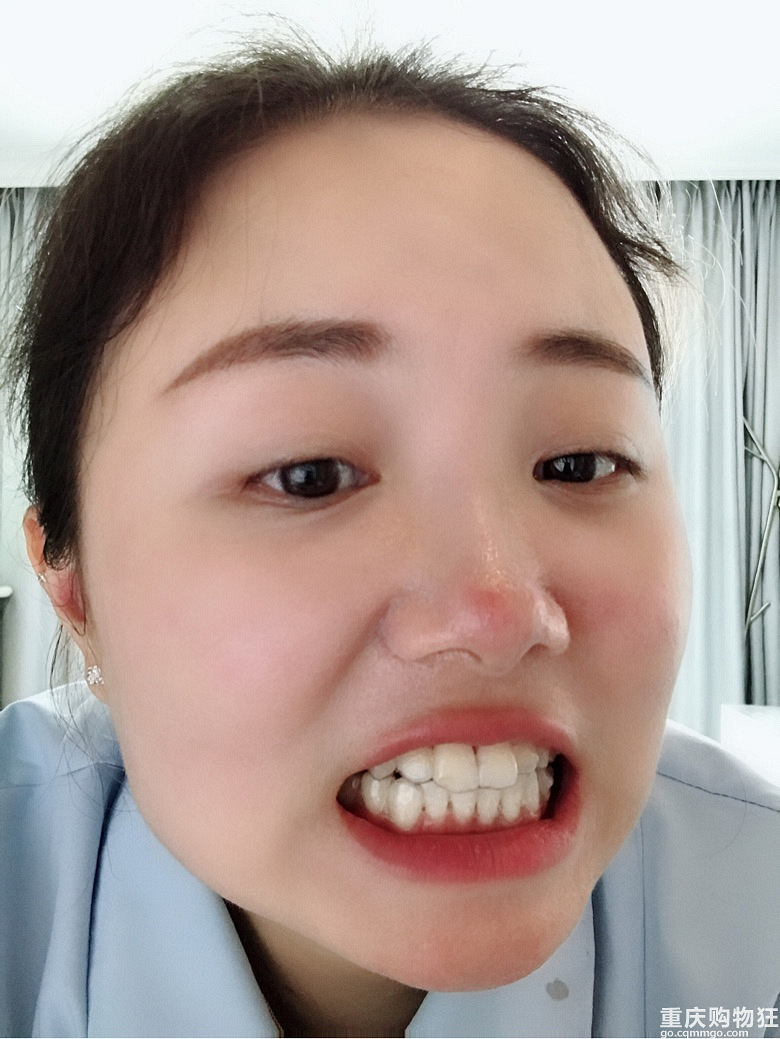 终于戴上了隐形牙套